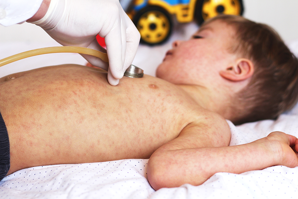 child with measles rash beeing looked at by a doctor